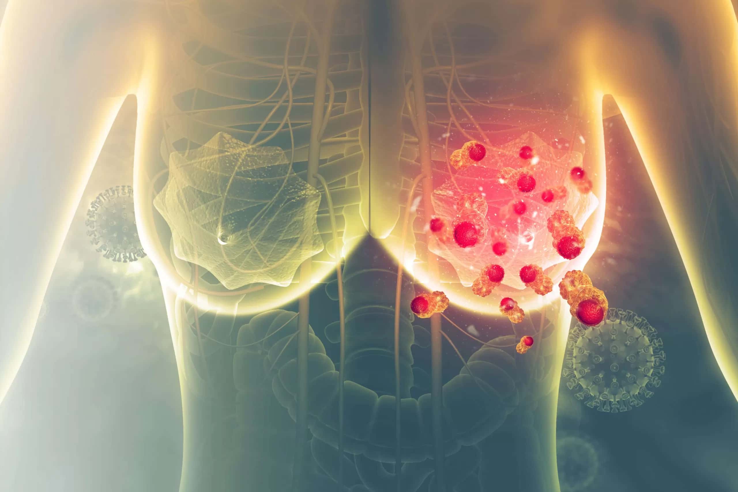 Sad: The breast – cancer patient dies four months without therapy